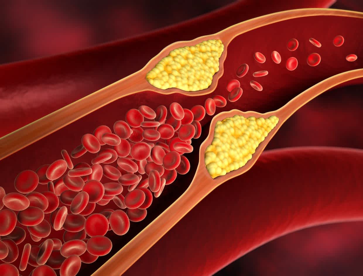 Cholesterol cao có thể có mối liên hệ mật thiết với rối loạn cương dương.