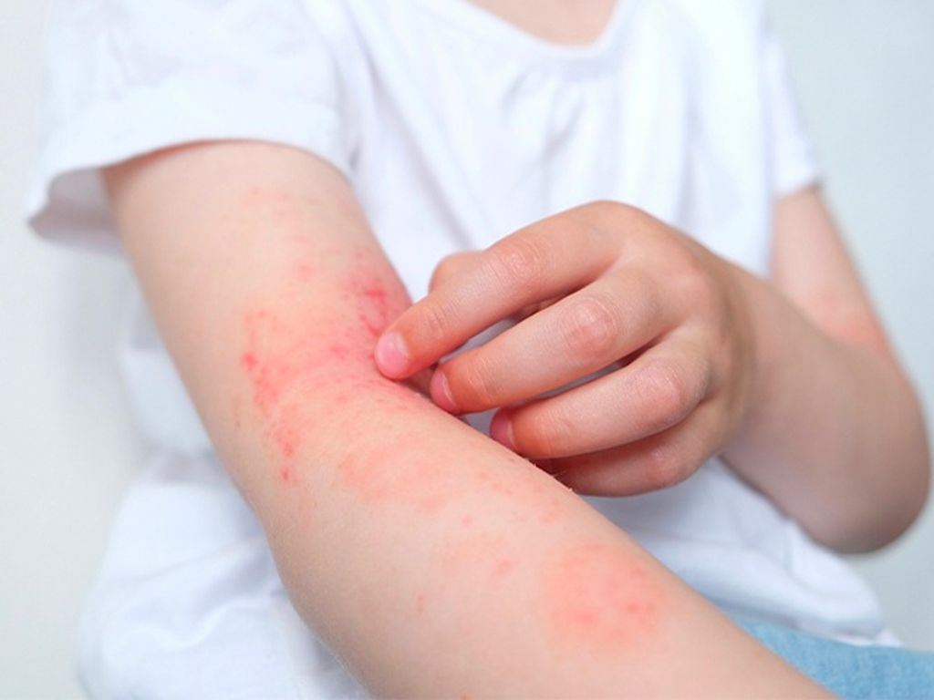 Bệnh viêm da cơ địa có đặc điểm hình thái tổn thương đa dạng, ngứa nhiều và hay tái phát.