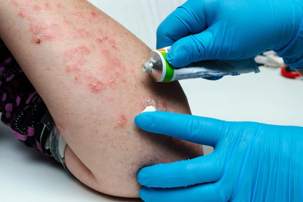 Thuốc bôi ngoài da thường dùng trong các trường hợp vẩy nến nhẹ đến trung bình.