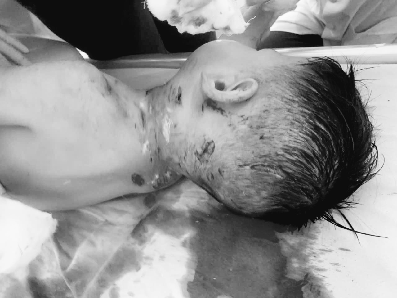 Bé 3 tuổi bị chó nhà hàng xóm cắn nhiều nhát vào vùng đầu, cổ, mặt.