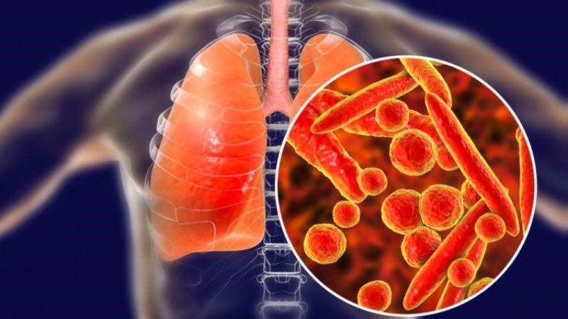 Lao phổi là bệnh truyền nhiễm do vi khuẩn lao gây ra tại phổi của người bệnh.