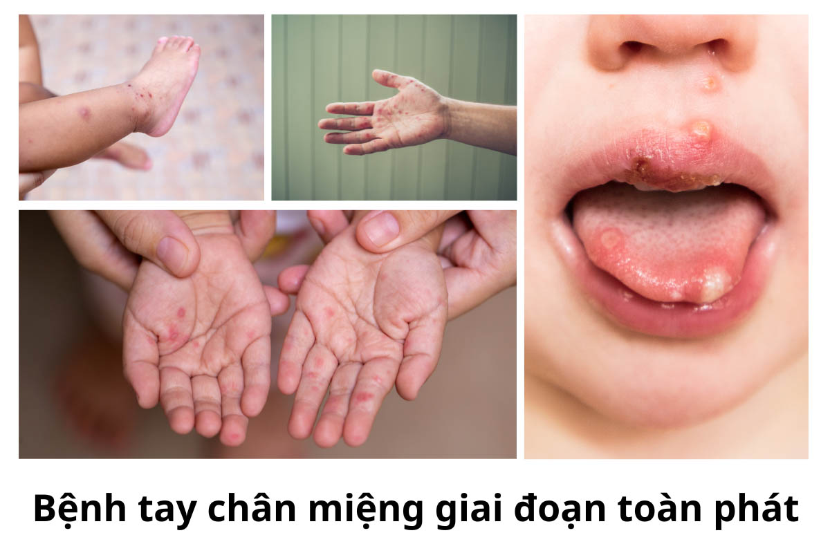 Giai đoạn toàn phát tay chân miệng thường kéo dài từ 3 – 10 ngày có biểu hiện phát ban dạng phỏng nước ở lòng bàn tay, bàn chân, đầu gối, mông.