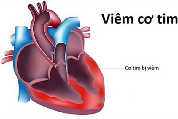 Viêm cơ tim có thể làm giảm khả năng co bóp của cơ tim và gây ra các rối loạn nhịp tim cấp tính, nguy hiểm.