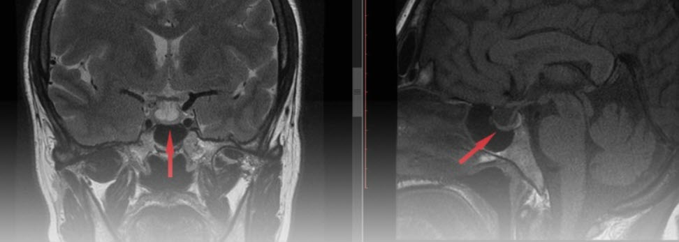 Hình ảnh MRI u tuyến yên – nguyên nhân hàng đầu gây suy tuyến yên hiện nay.