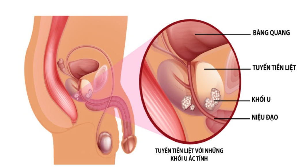 Mô phỏng cấu trúc tuyến tiền liệt và vị trí xuất hiện khối u ác tính.