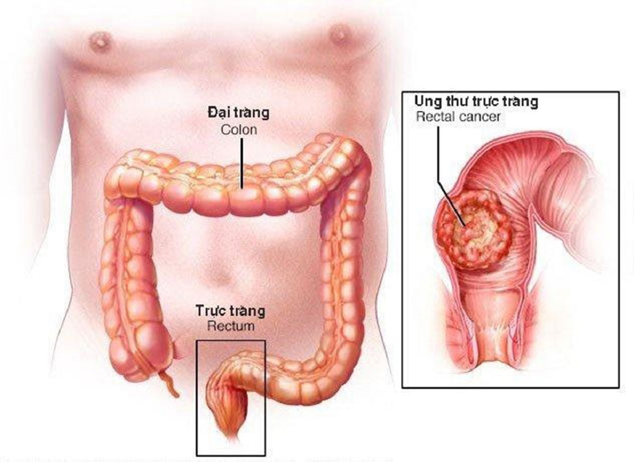 Ở giai đoạn sớm, ung thư đại trực tràng thường không có triệu chứng hoặc có triệu chứng mơ hồ, dễ nhầm lẫn với bệnh lý tiêu hóa thông thường