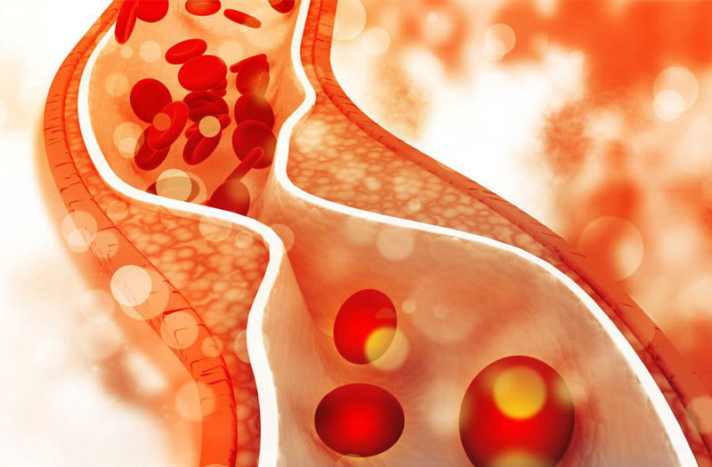 Rối loạn lipid máu thường gặp ở bệnh nhân đái tháo đường type 2.
