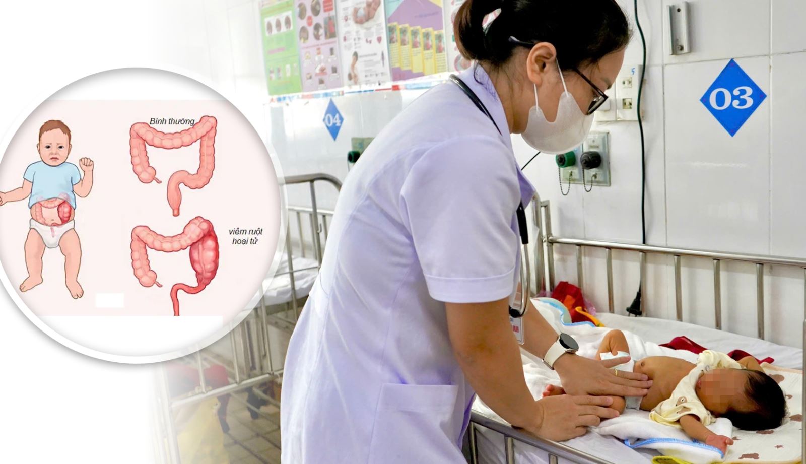 Các bác sĩ Khoa Sơ sinh, Bệnh viện Sản Nhi Nghệ An vừa điều trị thành công một ca viêm ruột hoại tử nguy hiểm ở trẻ sinh non.