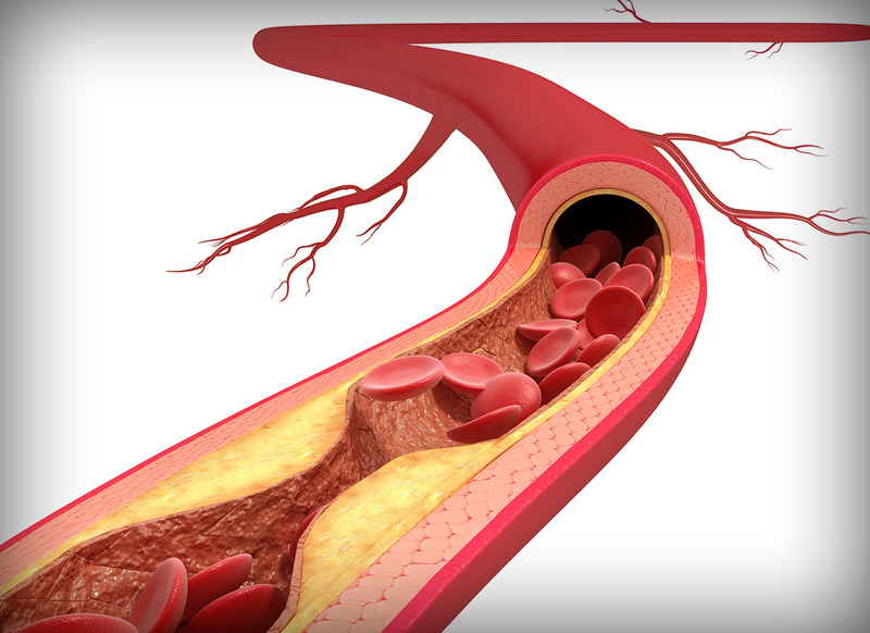 Xơ vữa động mạch là quá trình tự nhiên, tiến triển âm thầm.
