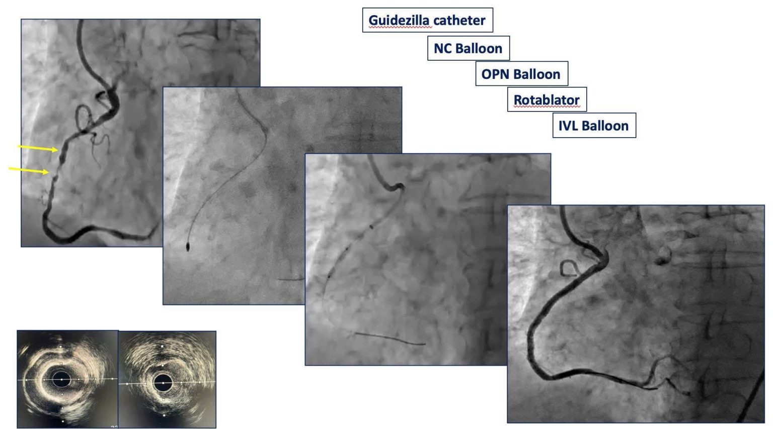 Hình ảnh chụp động mạch vành trước can thiệp và sau can thiệp của bệnh nhân T.T.N.