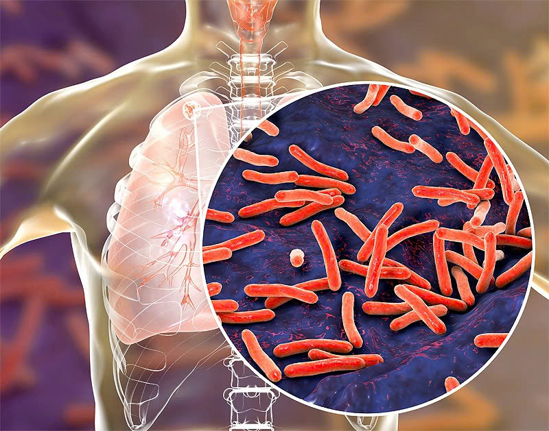 Với người nhiễm HIV, vi khuẩn lao dễ dàng bùng phát, từ dạng tiềm ẩn chuyển thành lao bệnh hoạt động.