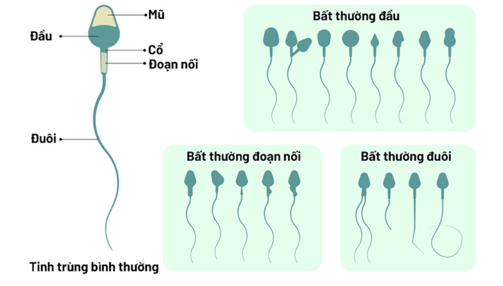 Tinh trùng bất thường flagella do đột biến gen CFAP65.