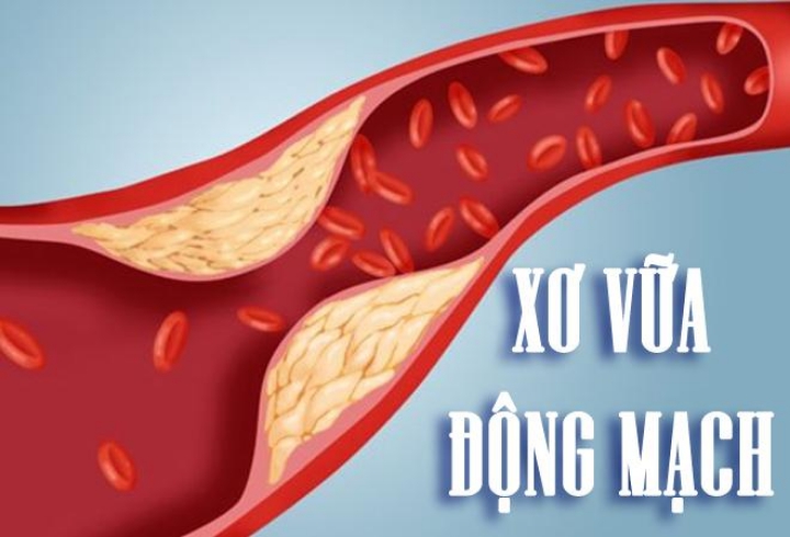Xơ vữa động mạch là nguyên nhân hàng đầu gây nhồi máu cơ tim, đột quỵ và tử vong sớm.