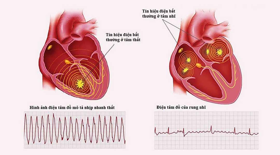Ở giai đoạn nhẹ triệu chứng rung nhĩ có thể chỉ xuất hiện thoáng qua
