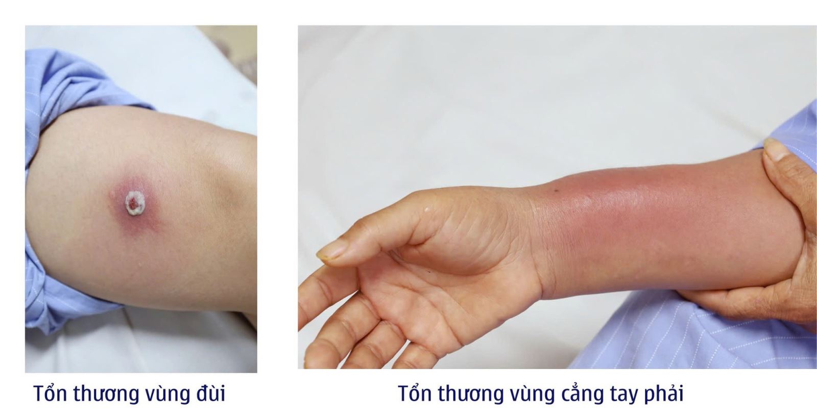 Sau cấy chỉ giảm đau xương khớp 2 ngày, cẳng tay phải người bệnh sưng nề, các ngón tay khó cử động, vùng đùi xuất hiện vết thương sưng tấy, có mủ.