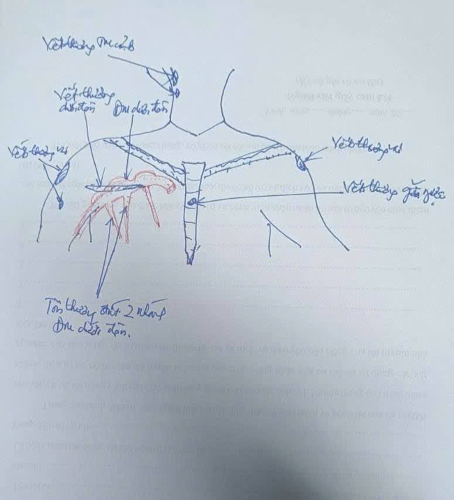Những nhát dao điều dưỡng Trang bị đâm. Phác họa: Bác sĩ cấp cứu