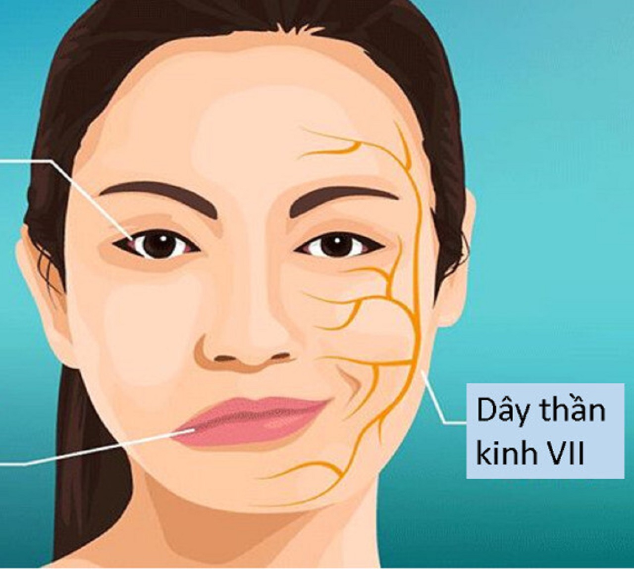 Liệt dây thần kinh số VII là tình trạng mất vận động hoàn toàn hay một phần các cơ của nửa mặt, do tổn thương dây thần kinh mặt.
