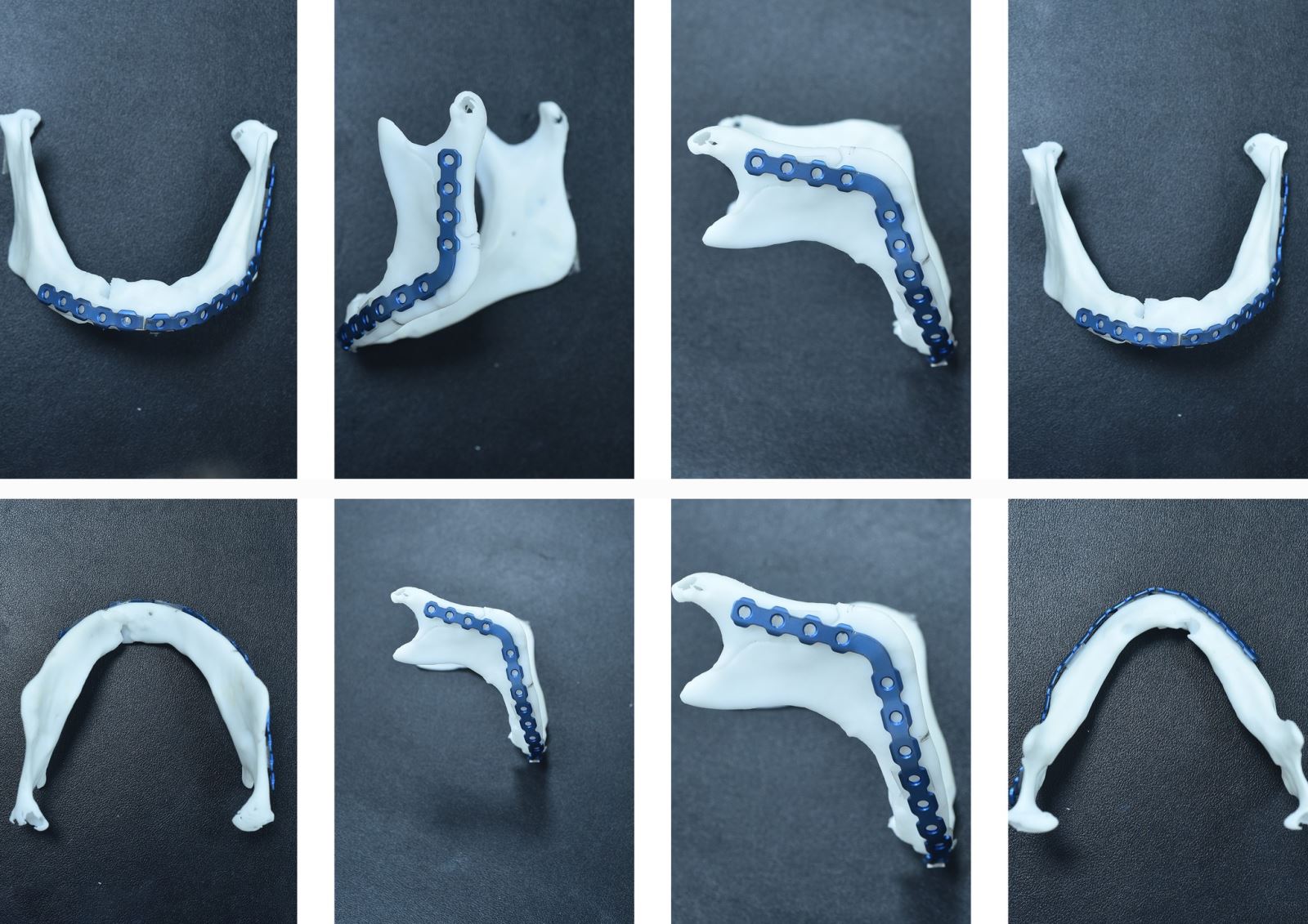 Dùng công nghệ 3D tạo một nẹp titan dùng trong phẫu thuật cho người bệnh.