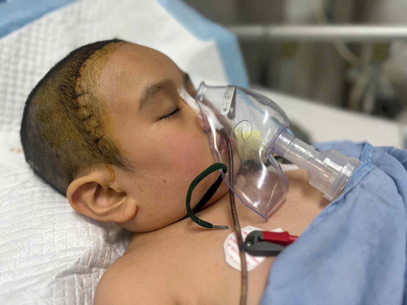 Bé Như Ý đang phải điều trị vì căn bệnh u sọ hầu ở não