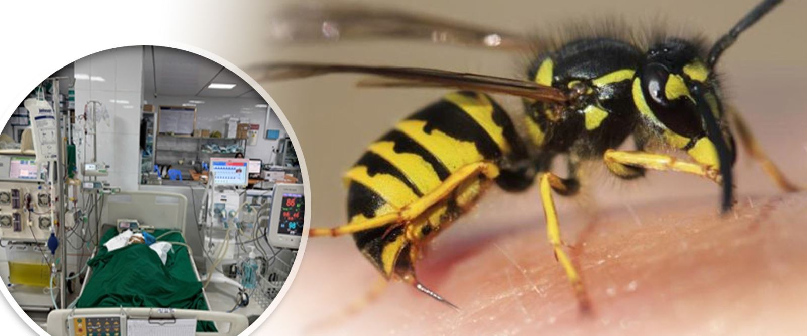 Cứu sống bé gái bị ong vò vẽ đốt hơn 50 nốt gây suy đa tạng.