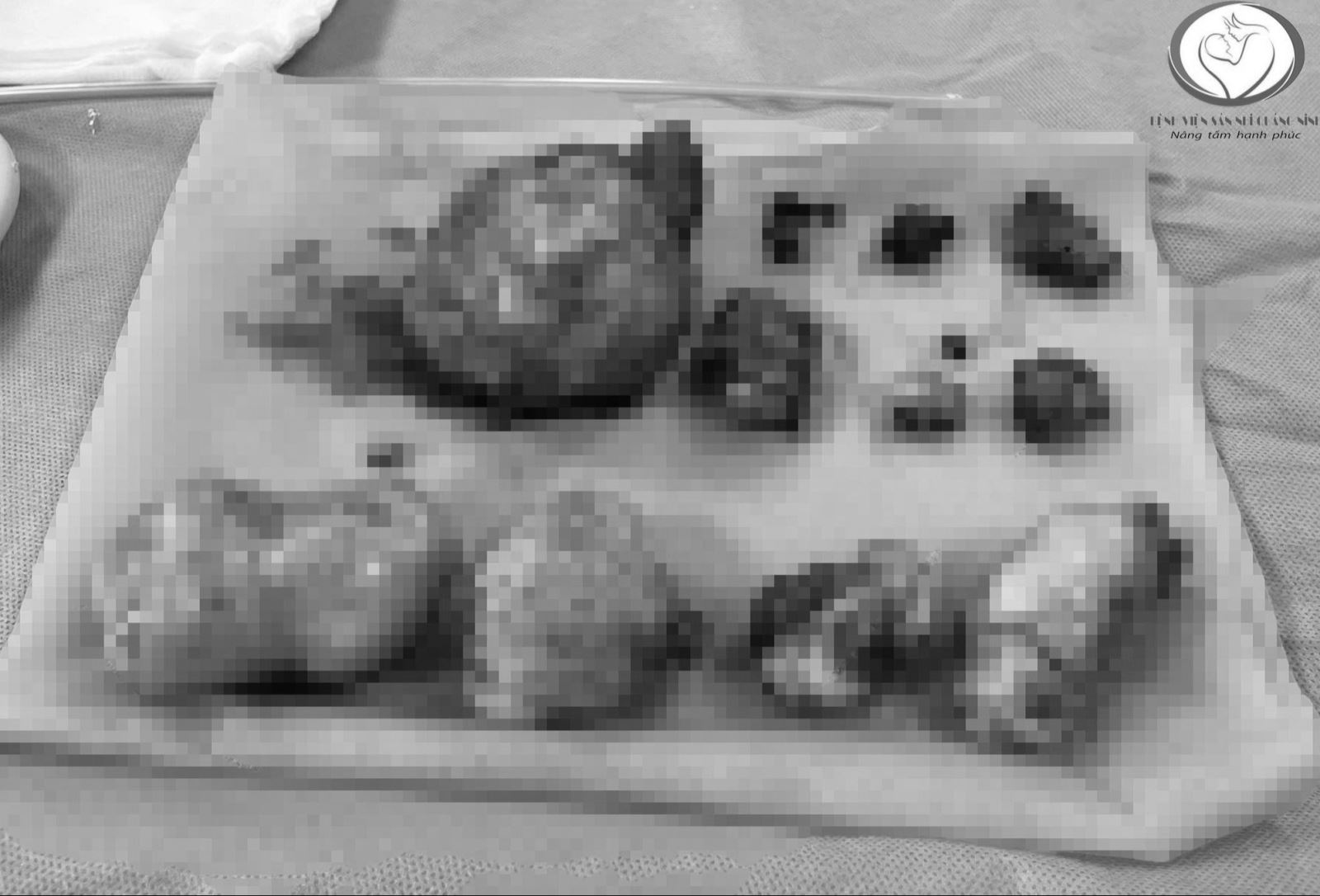 Người phụ nữ mang trong mình 11 khối u xơ.