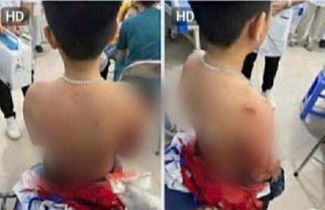 Hình ảnh cháu Th ở Lào Cai bị bạn học đâm nhiều nhát vào người.