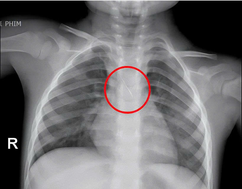 Dị vật trong đường thở cháu bé.