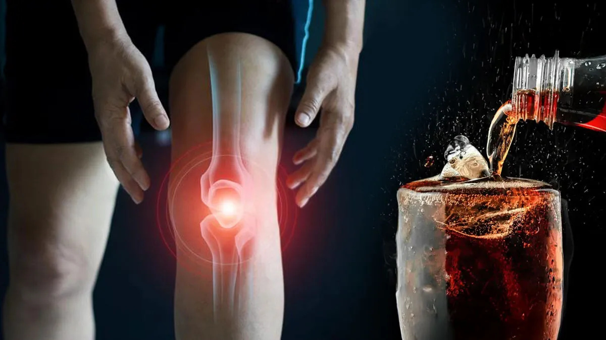 Người trẻ hiện nay tiêu thụ nước ngọt có gas nhiều hơn, khiến nguy cơ giảm mật độ xương xuất hiện từ rất sớm.