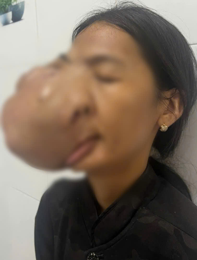 Chị H, 38 tuổi trước và sau phẫu thuật.