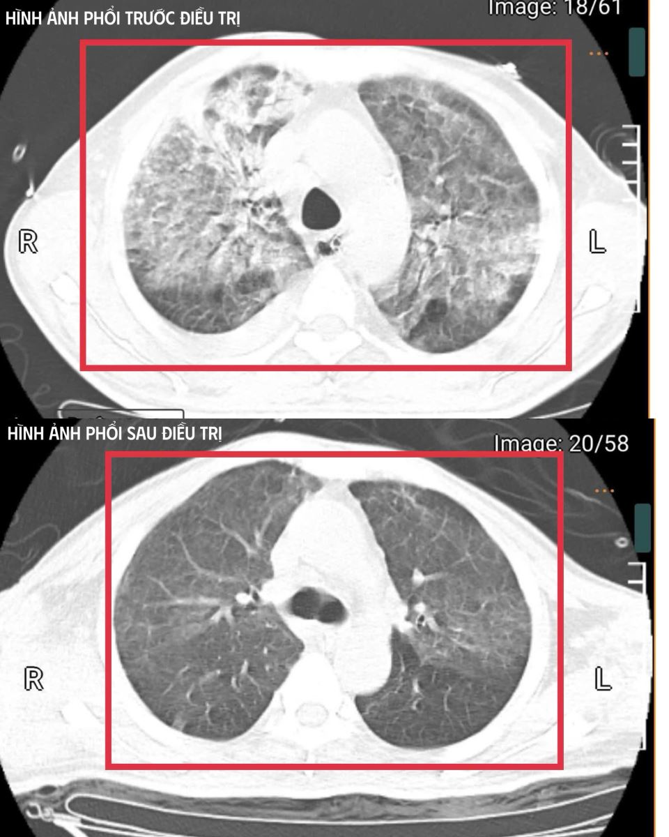 Hình ảnh chụp phổi của bệnh nhân mắc Whitmore.