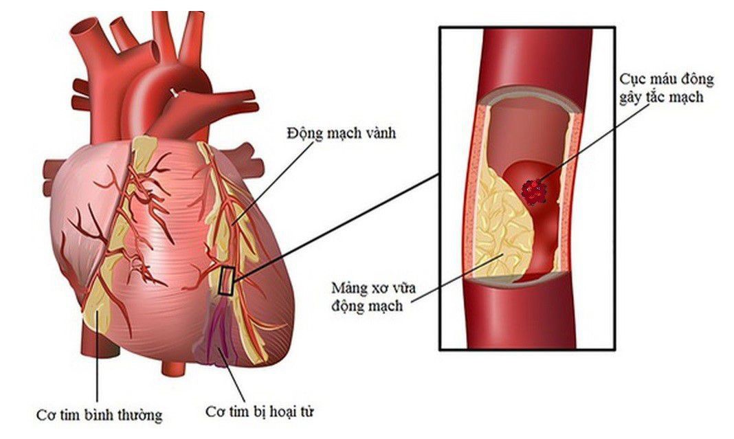 Thời tiết lạnh có thể gây gánh nặng lớn cho hệ tim mạch, đặc biệt ở người mắc bệnh động mạch vành.
