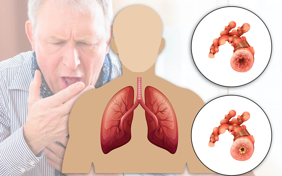 Bệnh phổi tắc nghẽn mạn tính (COPD) là bệnh lý hô hấp thường gặp