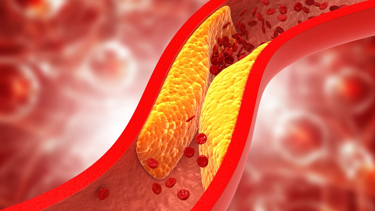 Cholesterol cao làm tăng nguy cơ bệnh tim mạch và đột quỵ.
