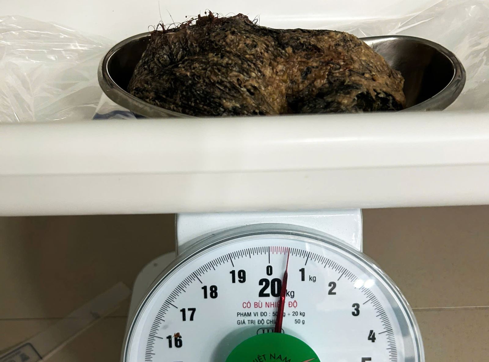 Búi tóc được lấy ra từ dạ dày bệnh nhi, nặng 0,5 kg.