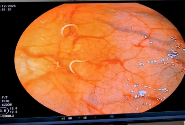 Hình ảnh giun tóc ký sinh ở đại tràng của bệnh nhân qua nội soi.