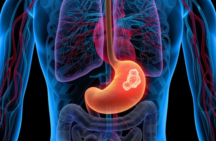 Các tế bào ung thư di căn khắp cơ thể, tỷ lệ chữa trị thành công rất thấp, nguy cơ tử vong cao.