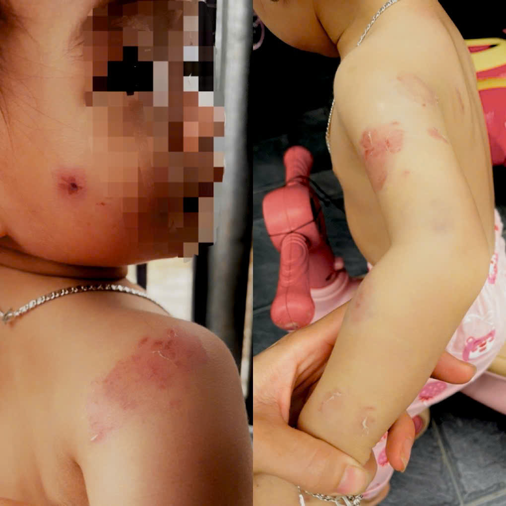 Nhiều vết thương trên người cháu N.