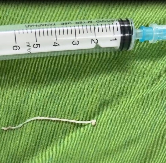 Hình ảnh Sán ký sinh trong khối u vùng ổ bụng của bệnh nhân.