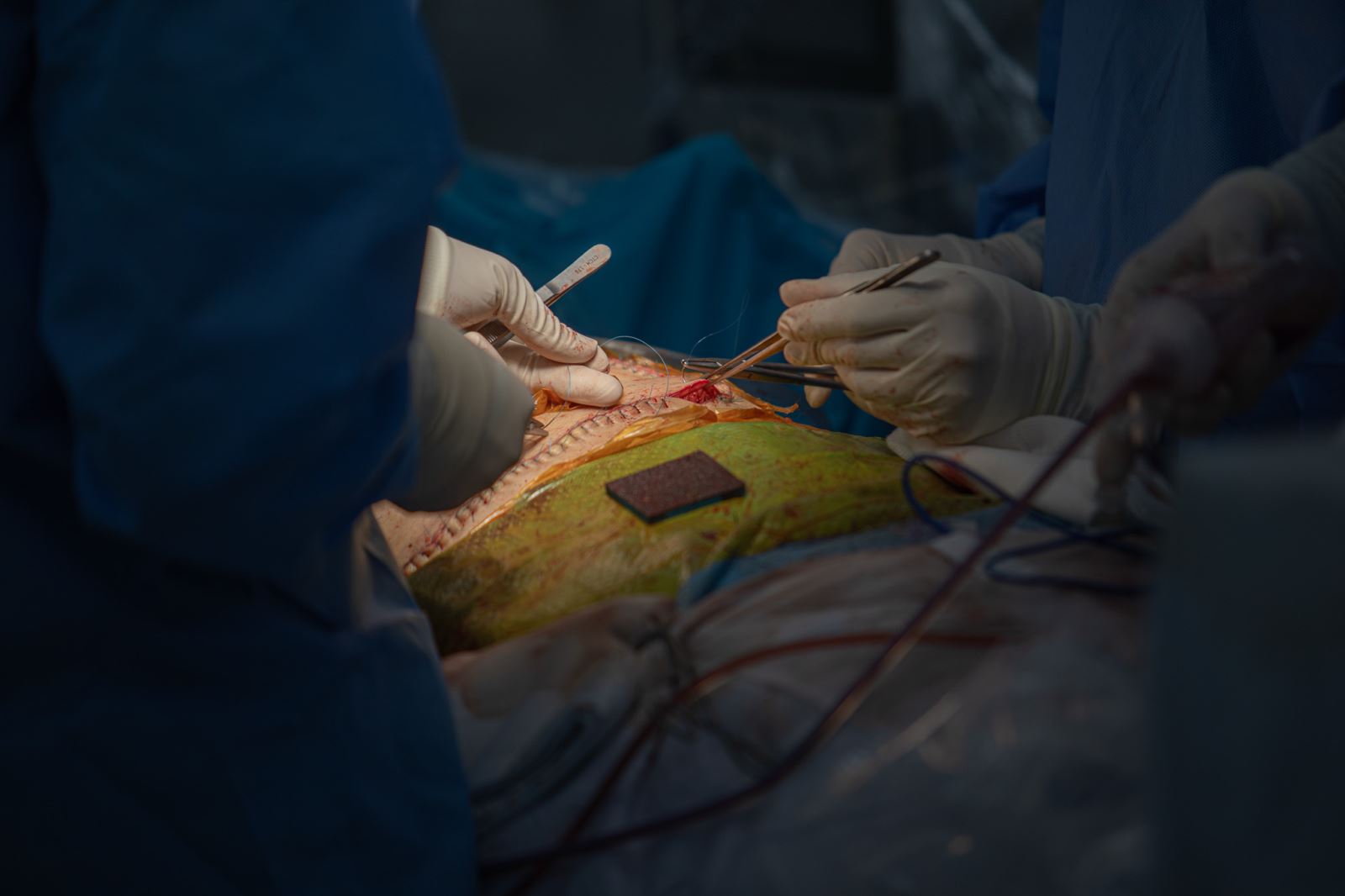 Hàng trăm cán bộ, y bác sĩ và nhân viên y tế thuộc nhiều chuyên khoa được huy động phối hợp chặt chẽ để bảo đảm ca phẫu thuật ghép gan diễn ra an toàn, thành công.