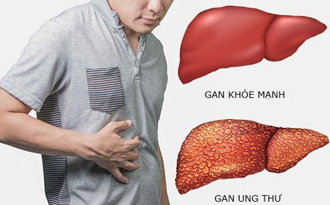 Uống nhiều rượu có thể gây xơ gan, là một yếu tố nguy cơ của ung thư gan.