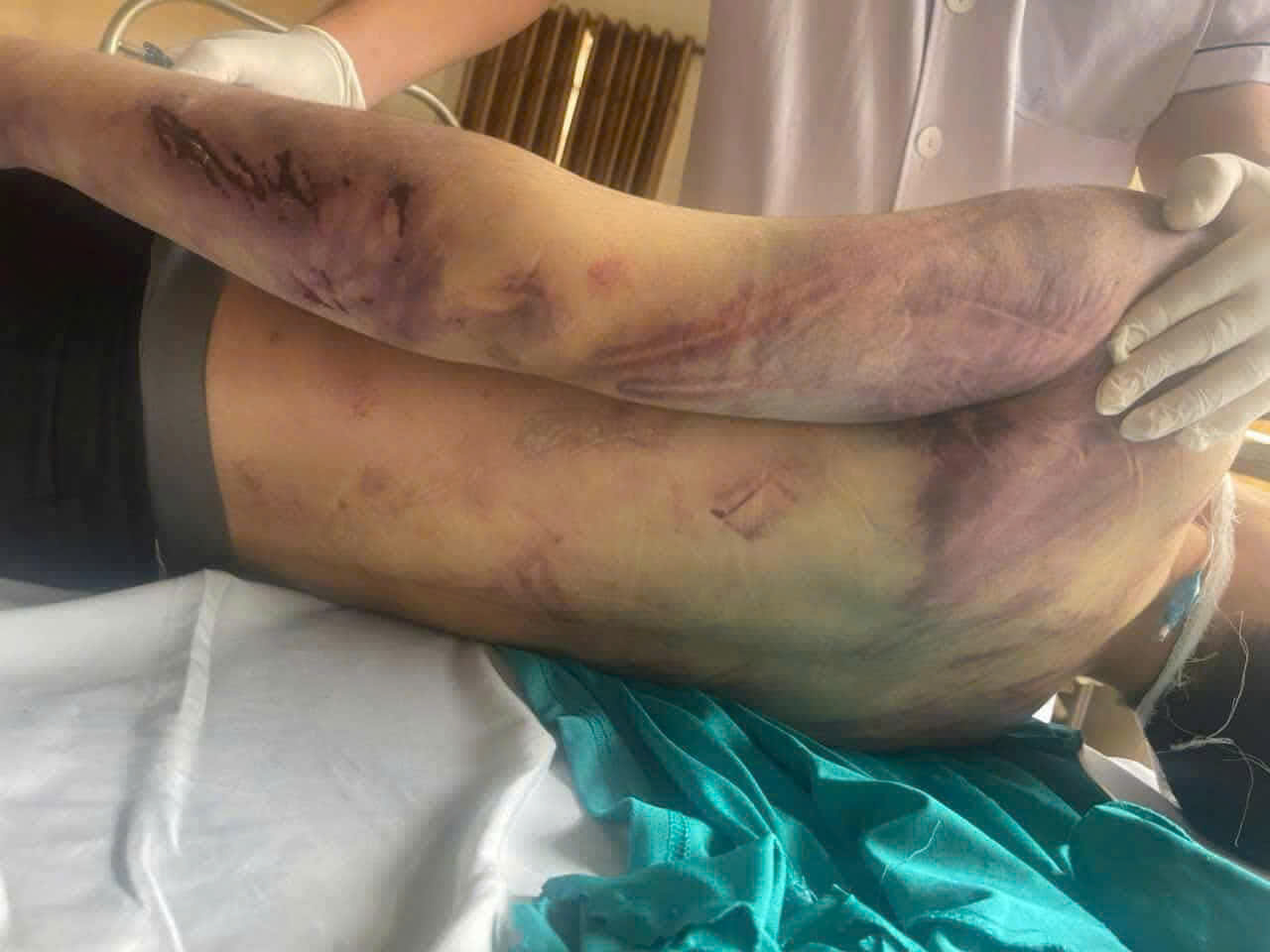 Nhiều vết bầm tím trên cơ thể học viên P.H.N. Ảnh: H.Đ.