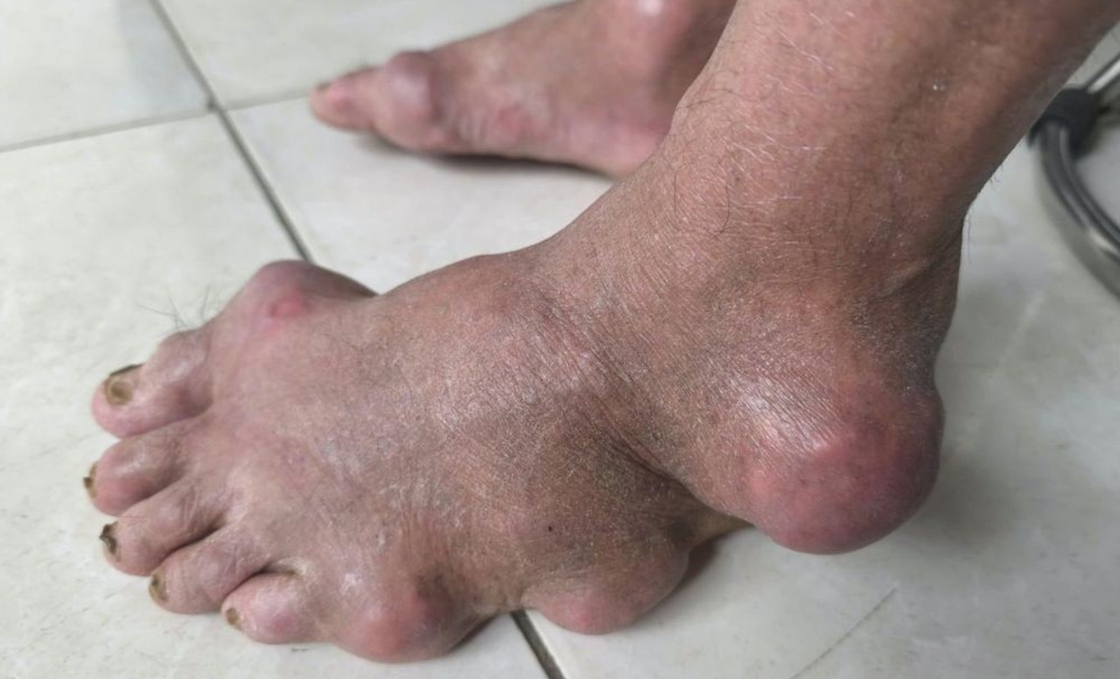 Bàn chân bị biến dạng của ông B.V.H.