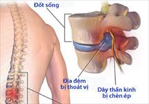 Thoát vị đĩa đệm: khi nào nên mổ?