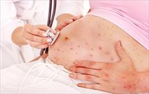 Mắc sốt xuất huyết khi mang thai có nguy hiểm?