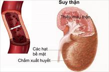 Dấu hiệu nhận biết chức năng thận suy giảm