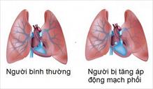 Tăng áp động mạch phổi và những lưu ý