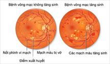 Phòng ngừa bệnh võng mạc đái tháo đường