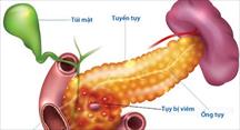 Biến chứng dễ gặp của viêm tụy mạn tính