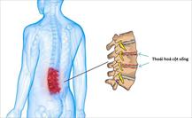Thoái hóa cột sống thắt lưng: Nguyên nhân, triệu chứng và cách điều trị hiệu quả