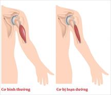 Bệnh loạn dưỡng cơ nguy hiểm thế nào, có thuốc điều trị khỏi bệnh không?